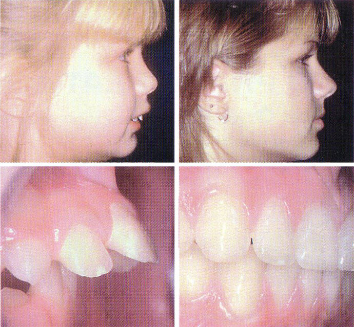 Orthodontic Child Photo