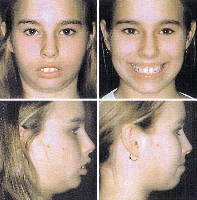 Orthodontics Child Jaw